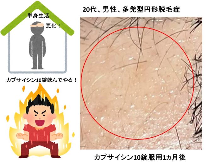 円形脱毛症　病院